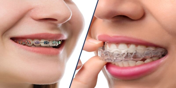 4. orthodontics 1